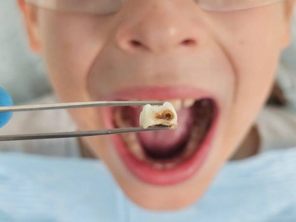 Best Dentist for Tooth Abscess  in Kaukauna, WI